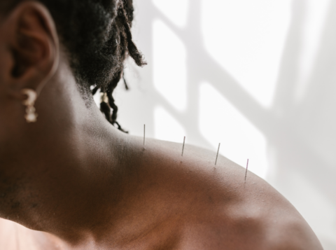 Dry Needling - Serenity PT & Wellness